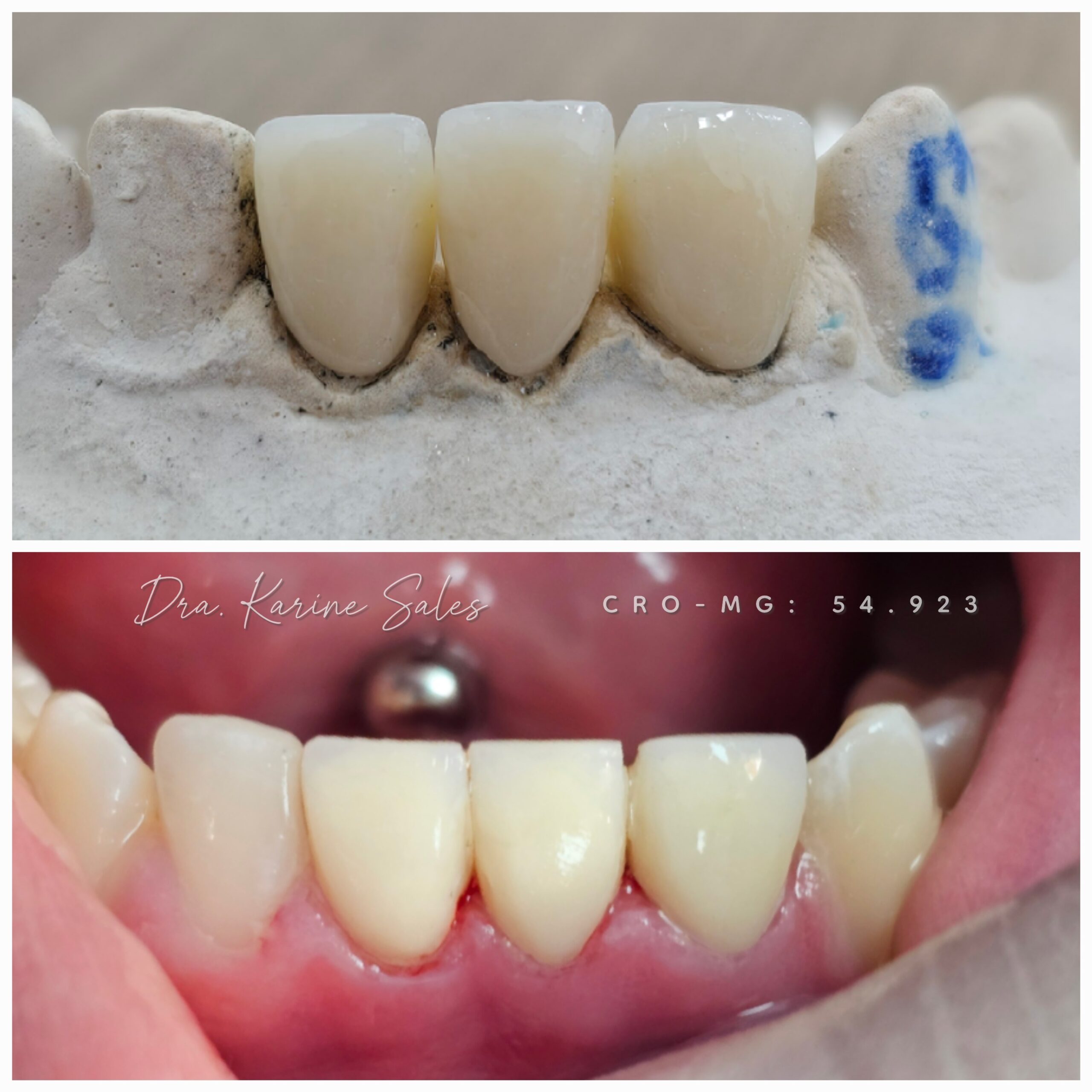Coroa total 12