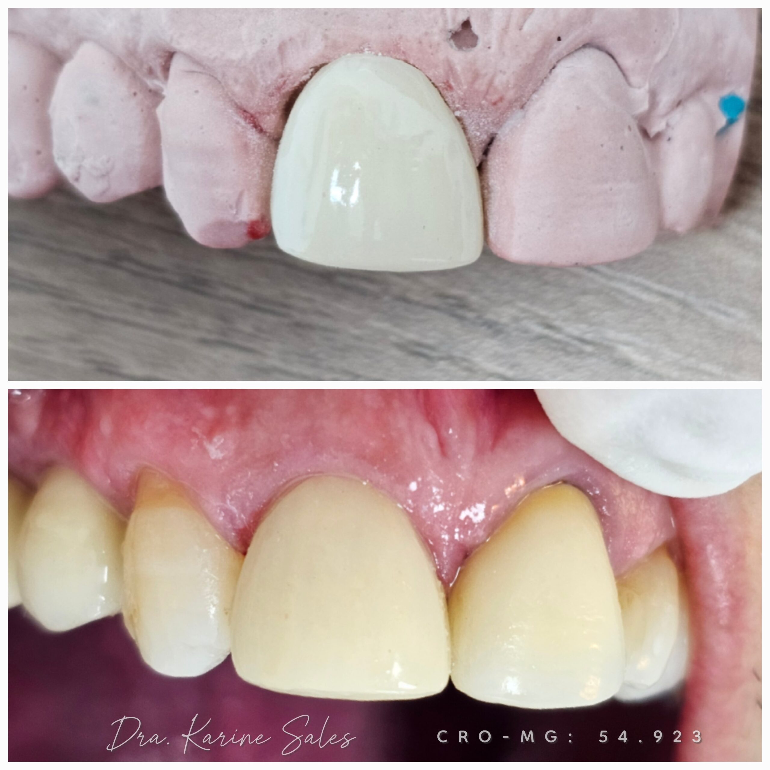 Coroa total 13