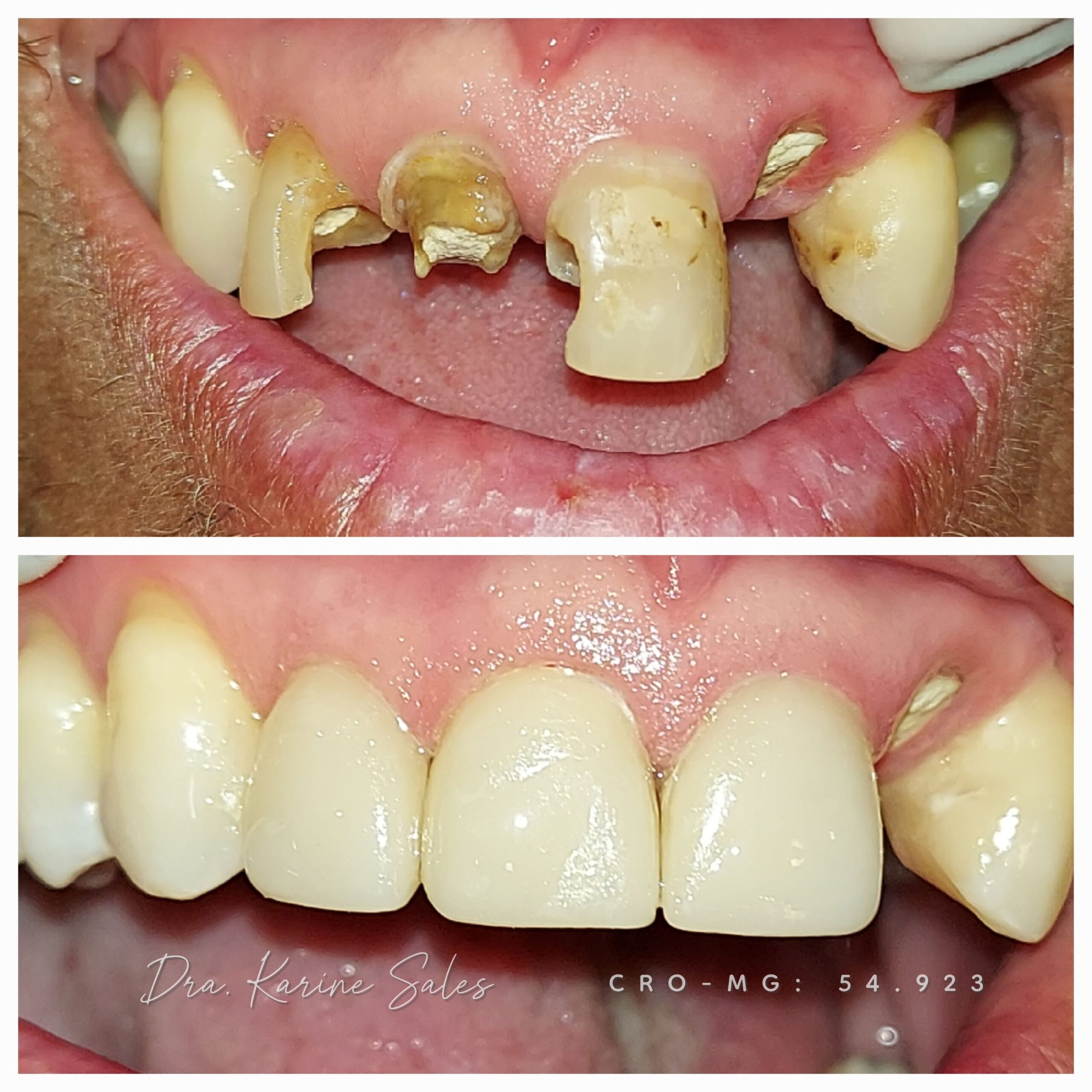 Coroa total 3