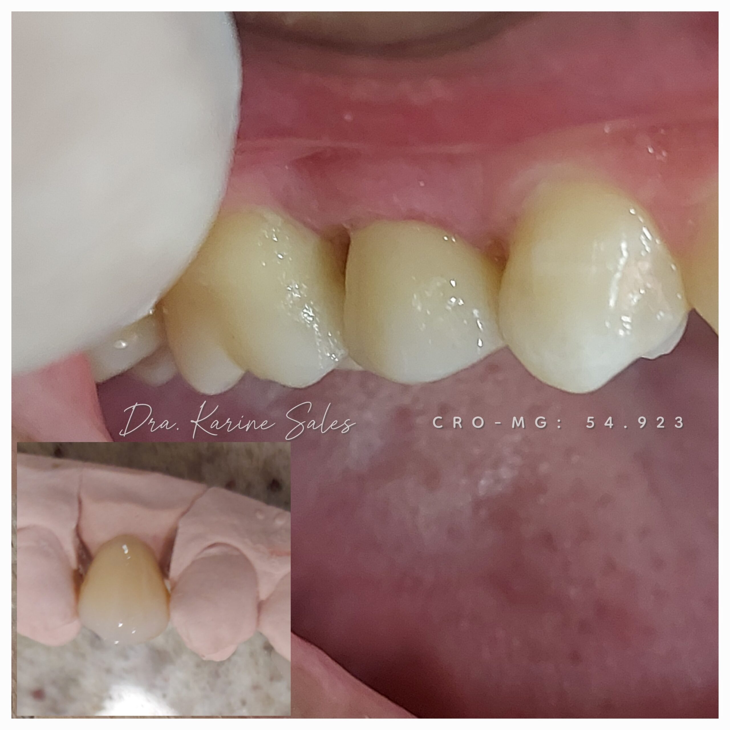 Coroa total 5