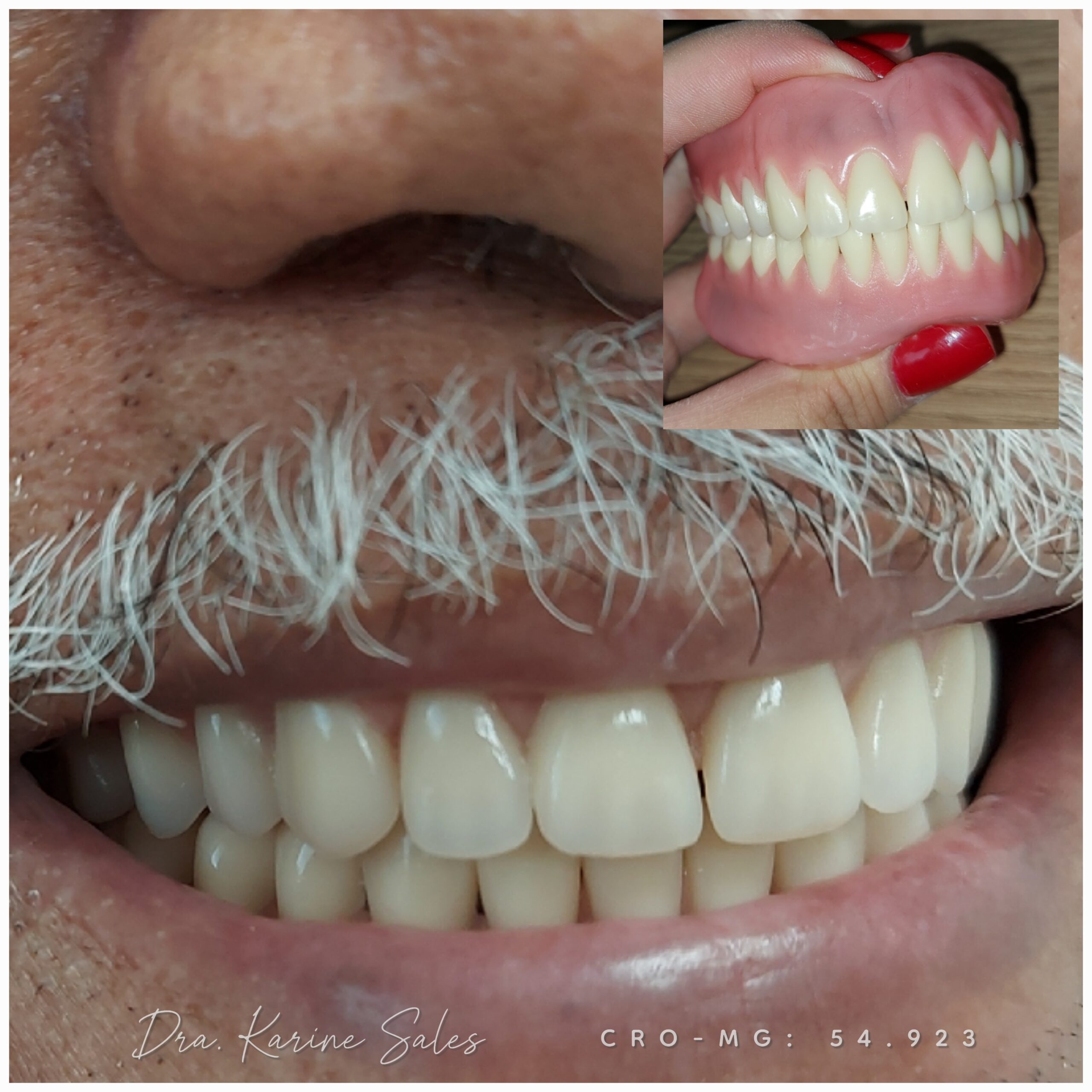 Dentadura 11